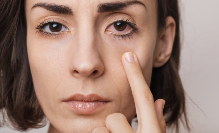 Dry Eye Image three