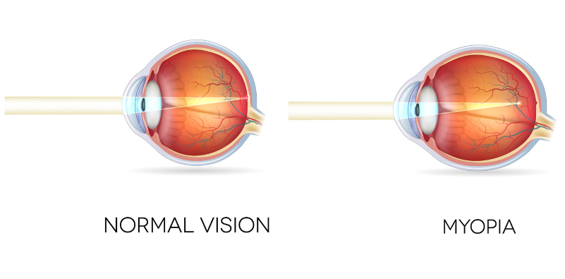what is myopia